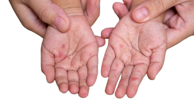 Hand Foot and Mouth Vomiting