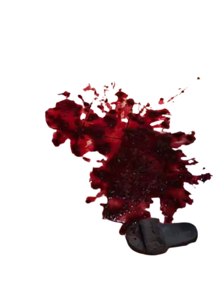 bloody vomit